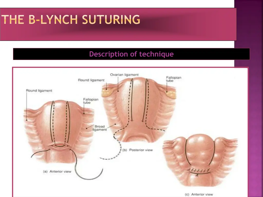 the b lynch suturing