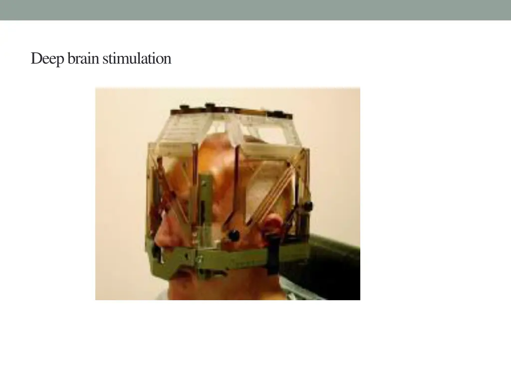 deep brain stimulation