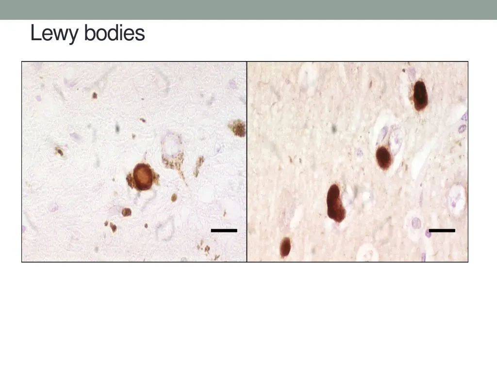 lewy bodies