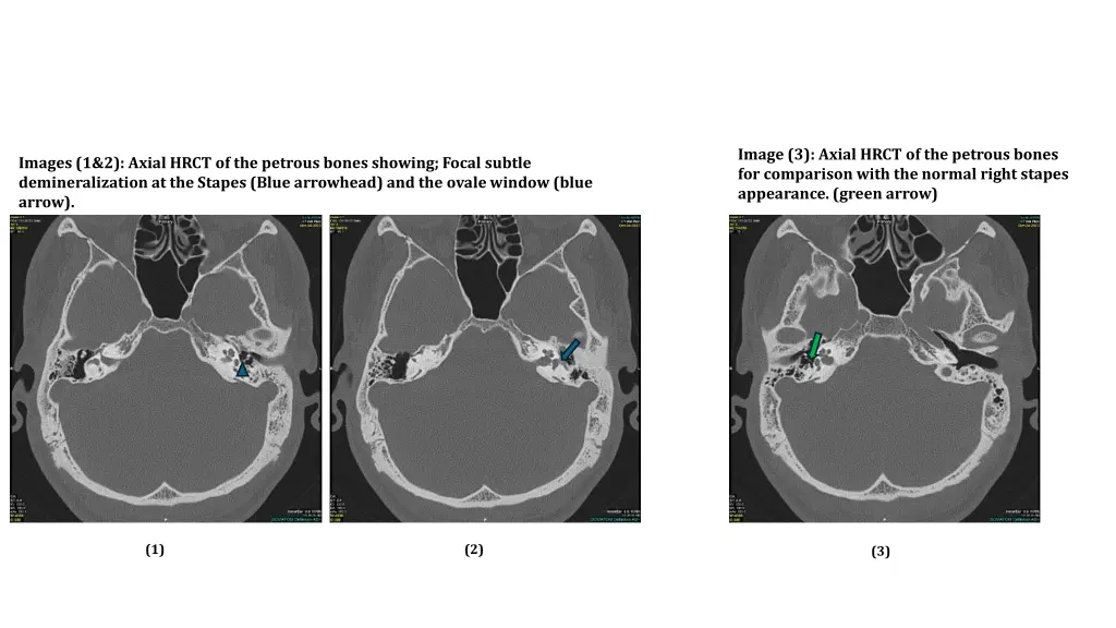 image 3 axial hrct of the petrous bones