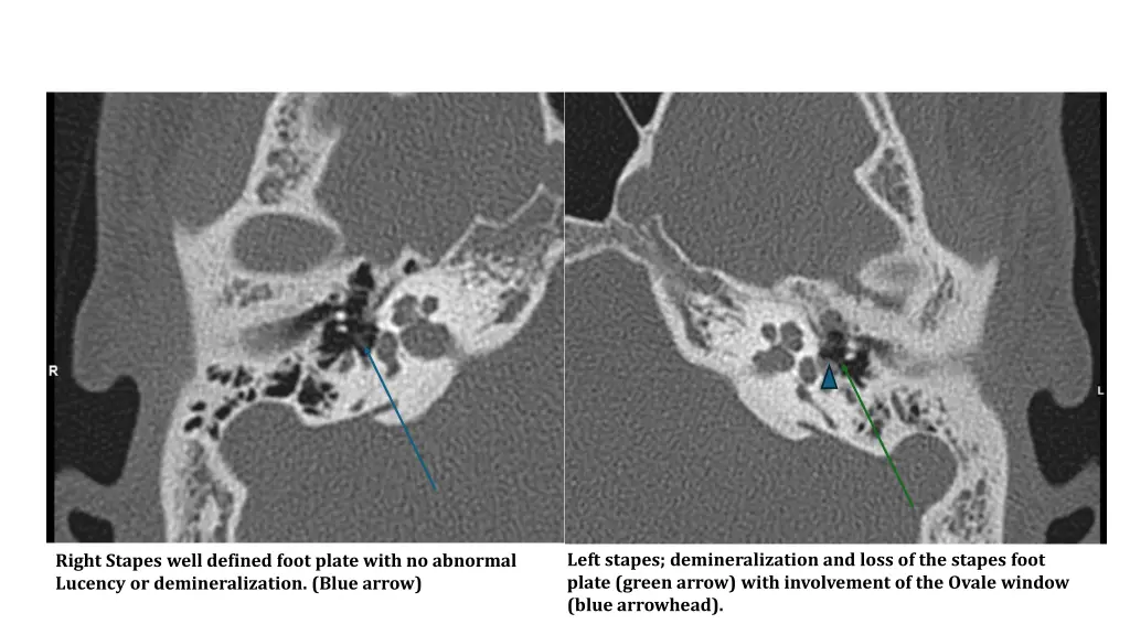 left stapes demineralization and loss