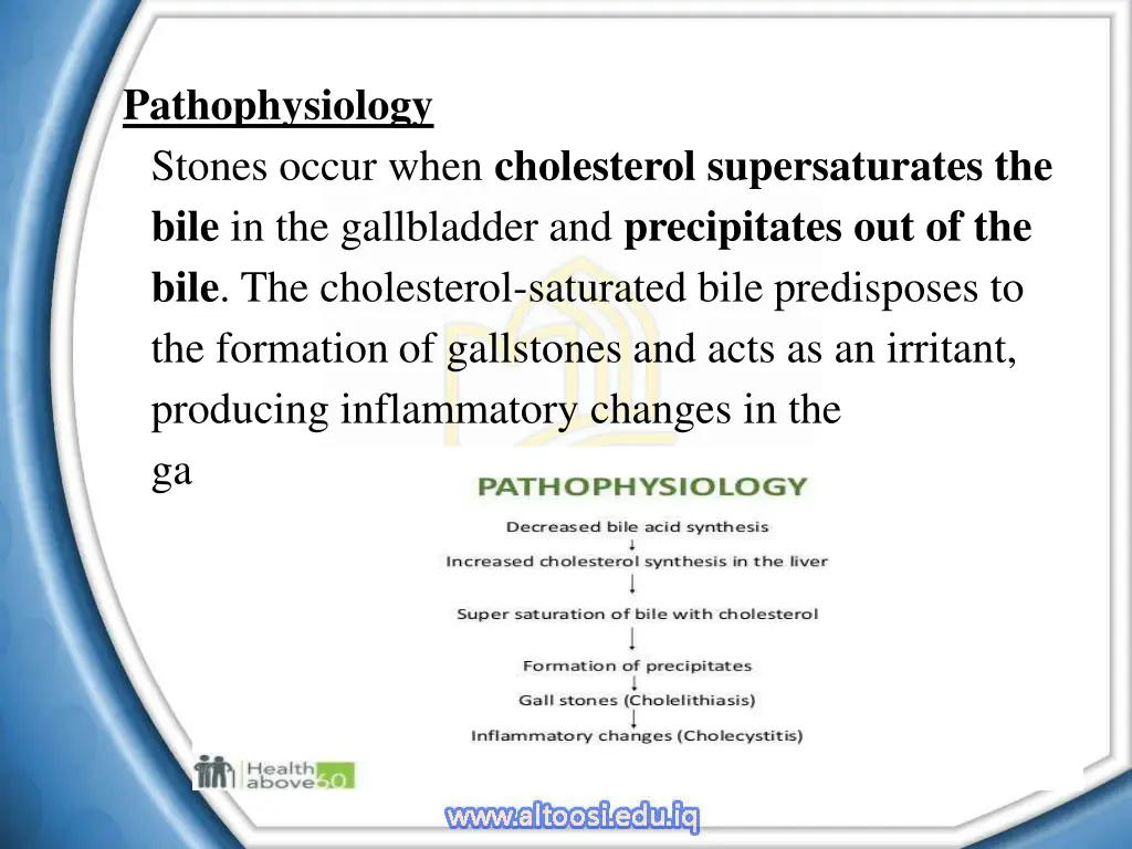 pathophysiology stones occur when cholesterol