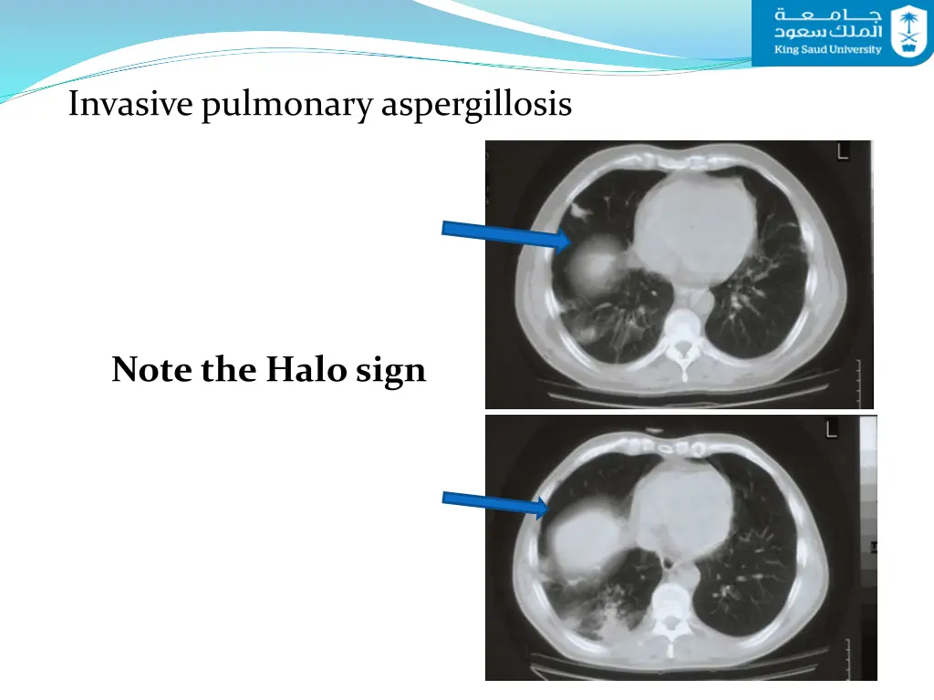 invasive pulmonary aspergillosis