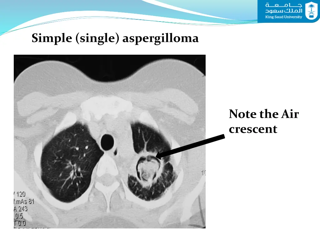 simple single aspergilloma