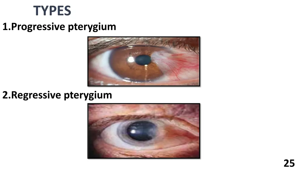 types