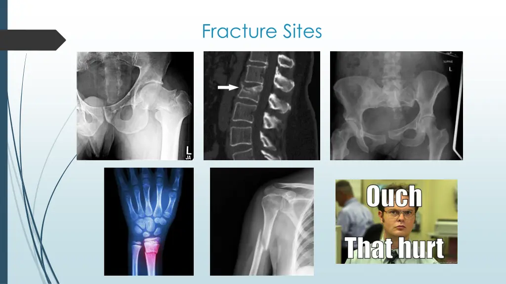 fracture sites