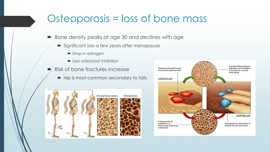 osteoporosis loss of bone mass