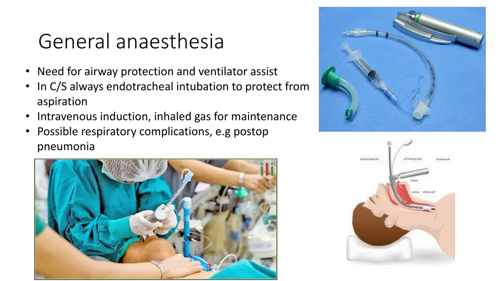 general anaesthesia