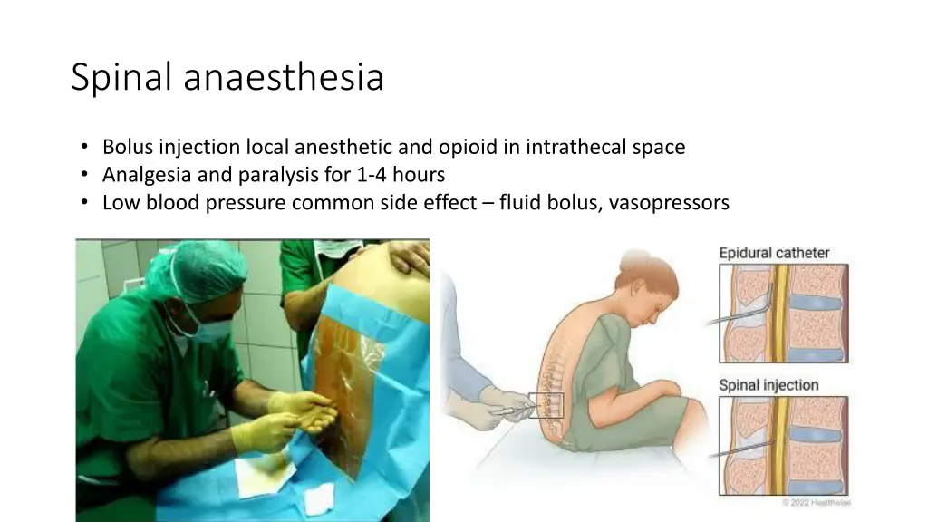 spinal anaesthesia