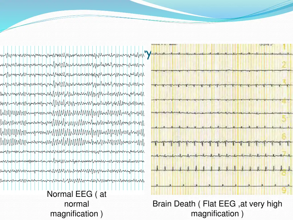 brain death confirmatory testing with eeg
