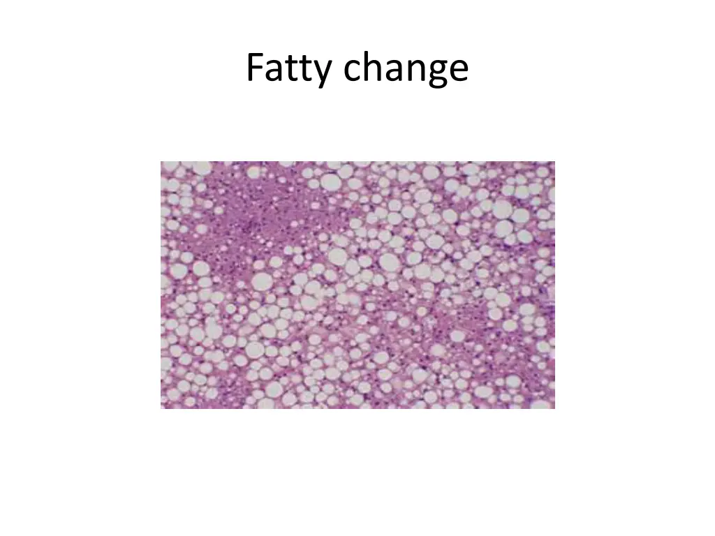 fatty change 1
