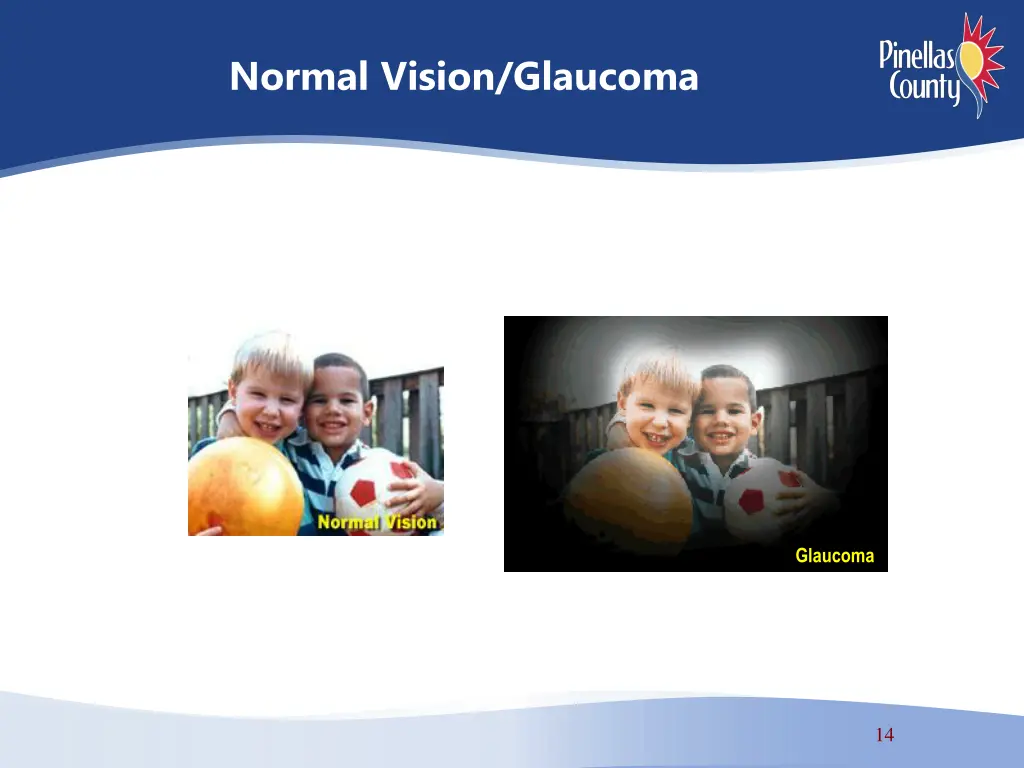 normal vision glaucoma