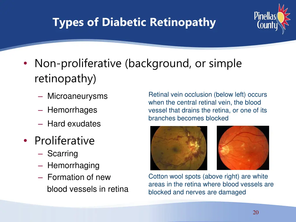 types of diabetic retinopathy