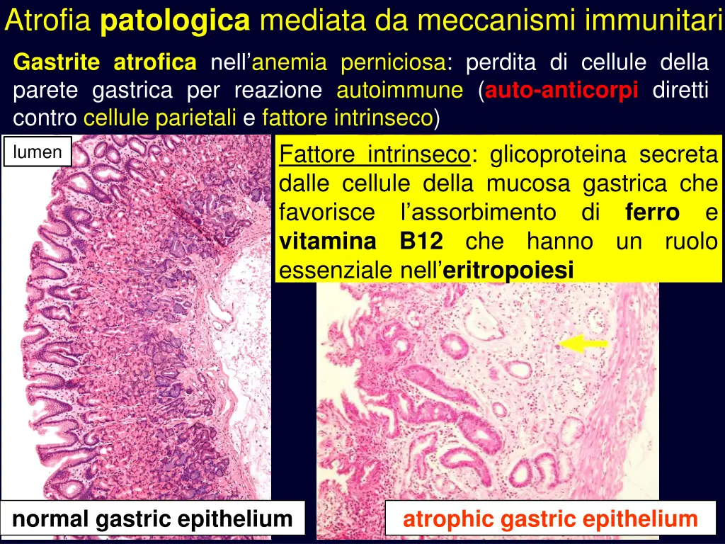 atrofia patologica mediata da meccanismi