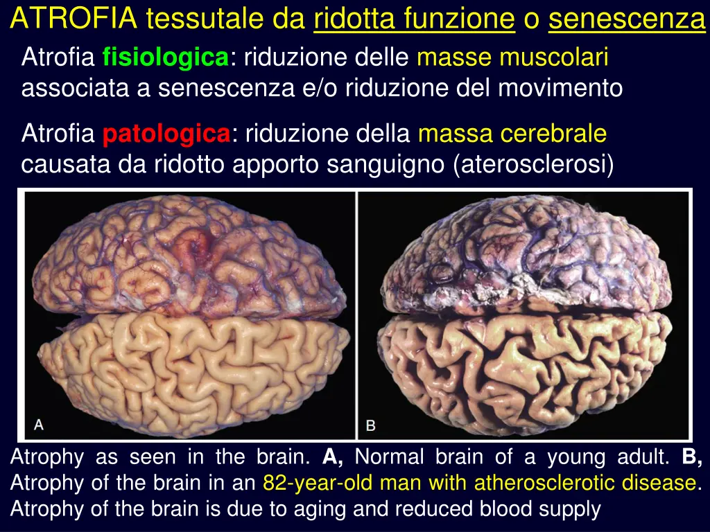 atrofia tessutale da ridotta funzione