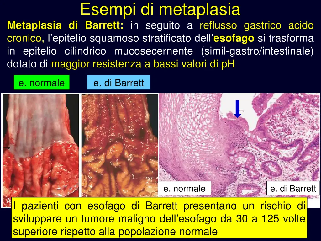 esempi di metaplasia metaplasia di barrett