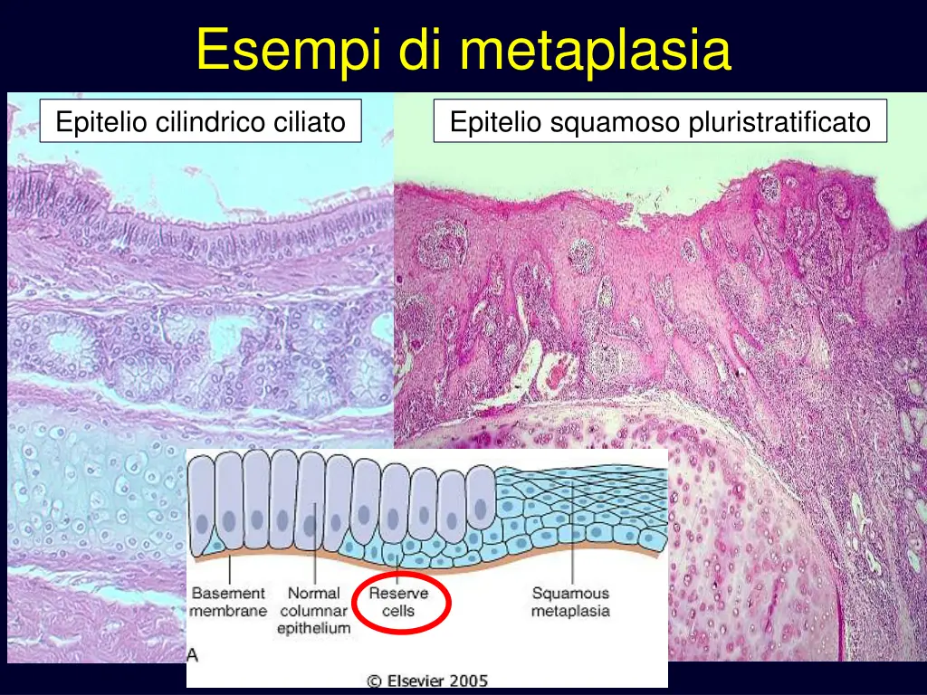 esempi di metaplasia