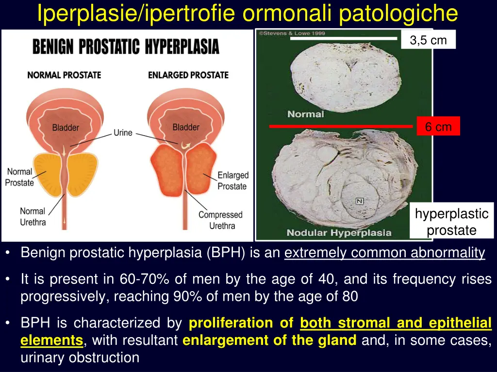 iperplasie ipertrofie ormonali patologiche