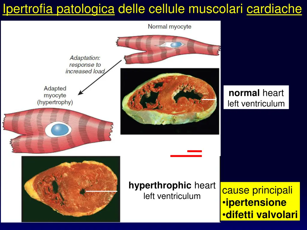 ipertrofia patologica delle cellule muscolari