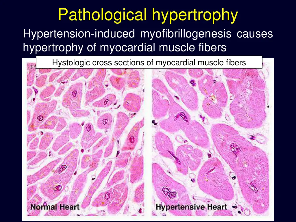 pathological hypertrophy hypertension induced