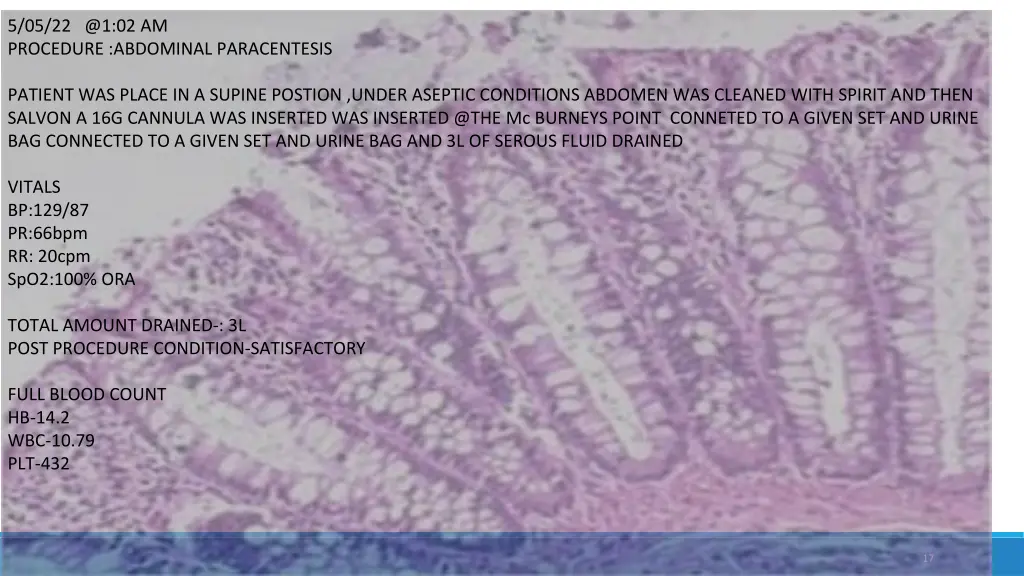 5 05 22 @1 02 am procedure abdominal paracentesis