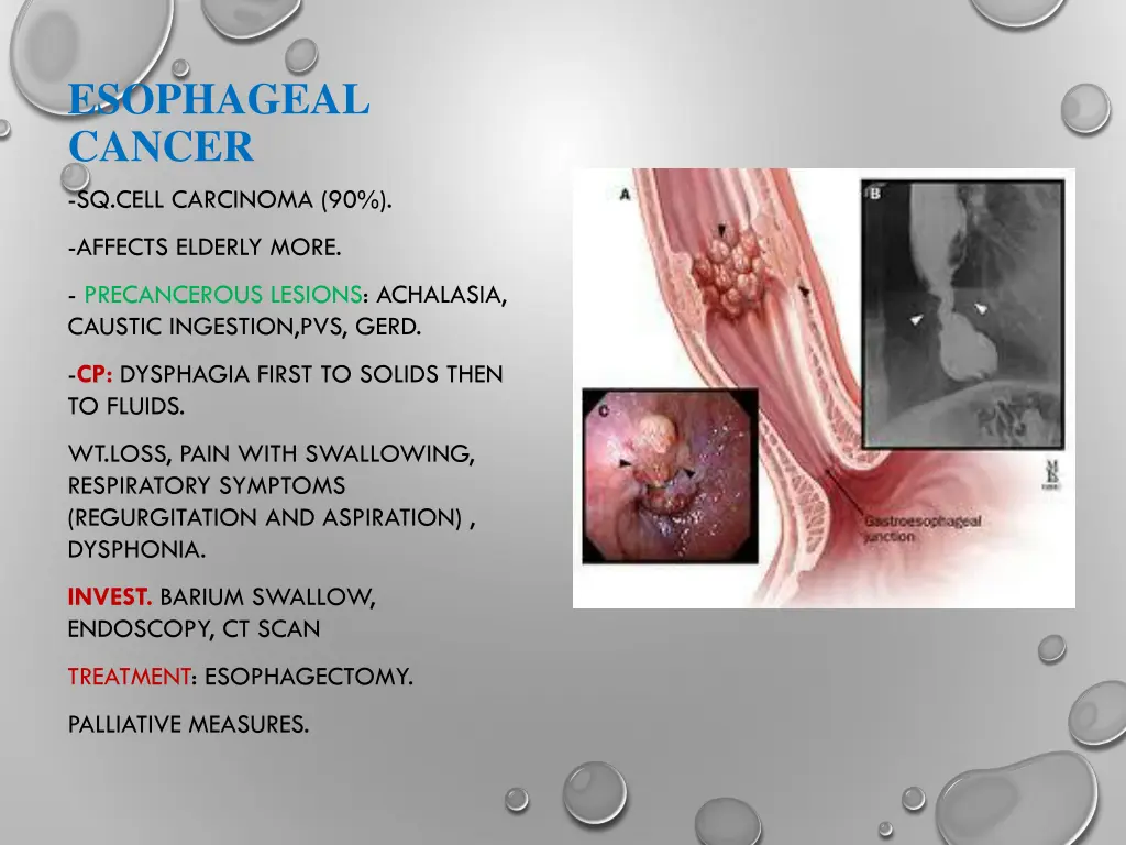 esophageal cancer