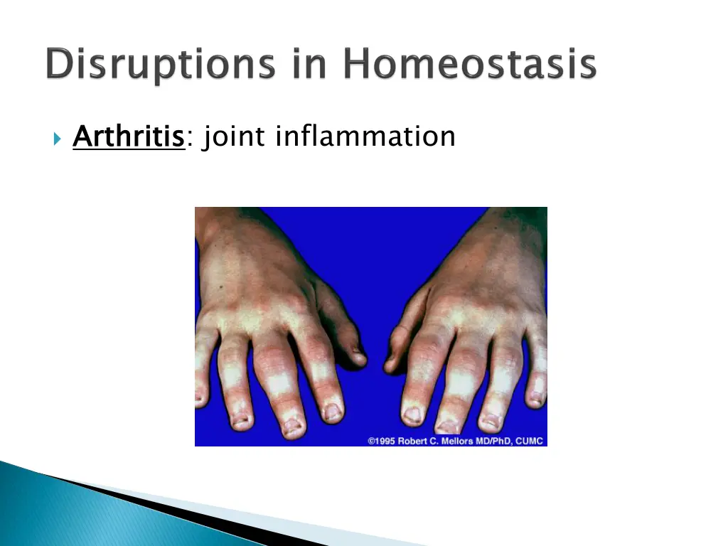arthritis