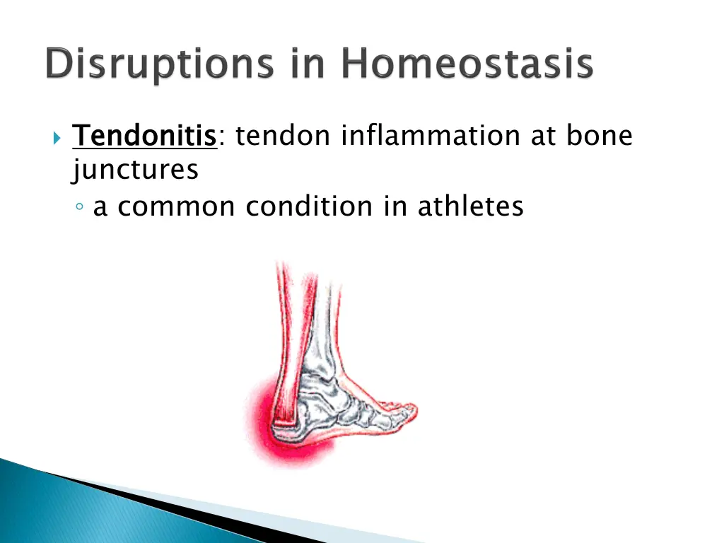 tendonitis junctures a common condition