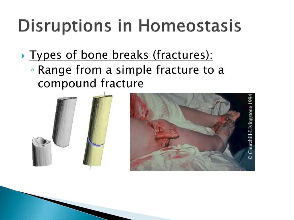 types of bone breaks fractures range from