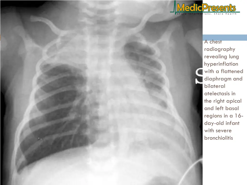 a chest radiography revealing lung hyperinflation