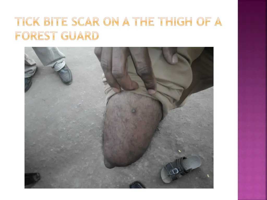 tick bite scar on a the thigh of a forest guard