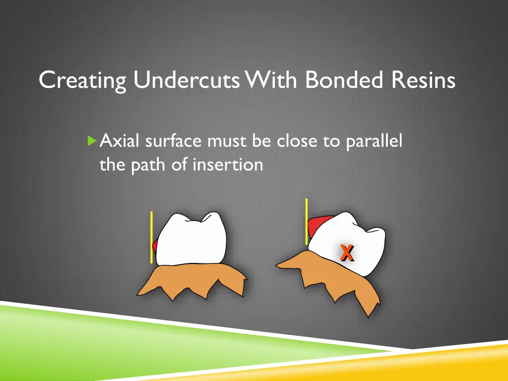 creating undercuts with bonded resins
