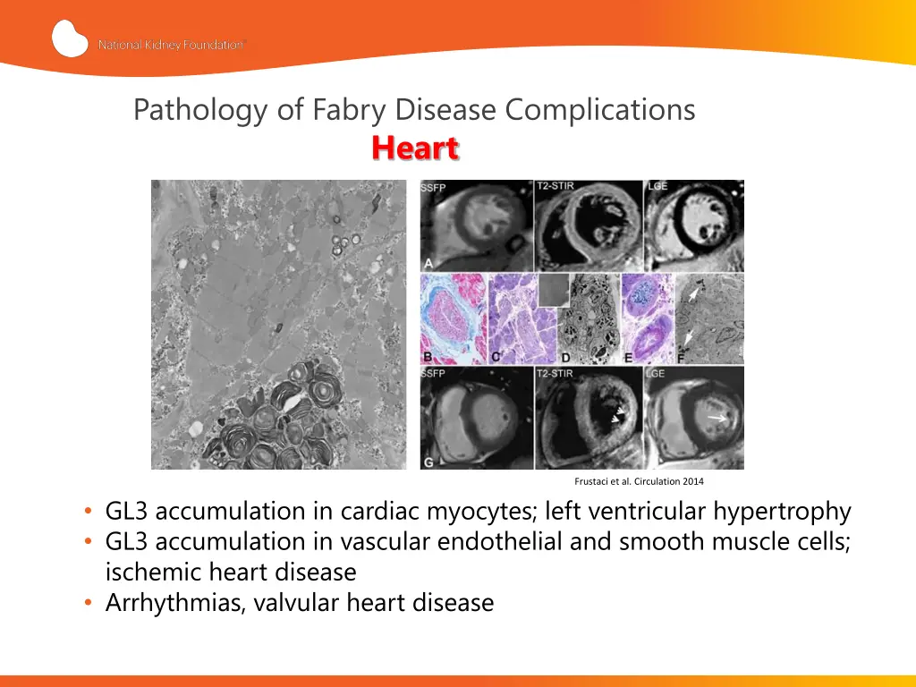 pathology of fabry disease complications heart