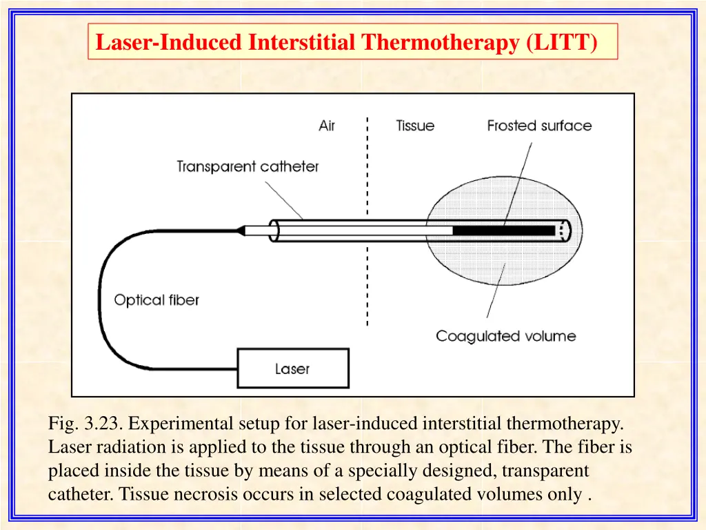 laser induced interstitial thermotherapy litt 2