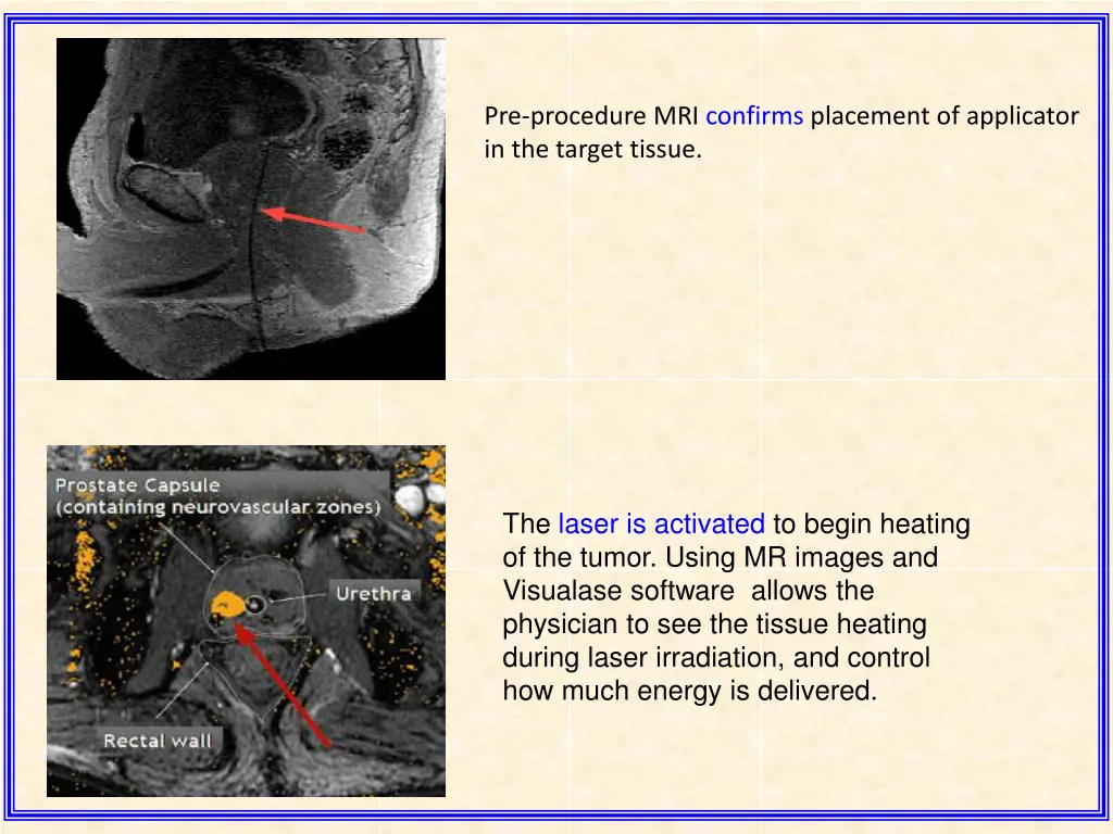 pre procedure mri confirms placement