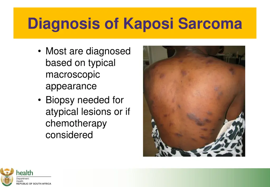 diagnosis of kaposi sarcoma