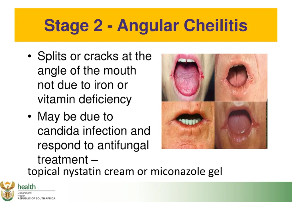 stage 2 angular cheilitis