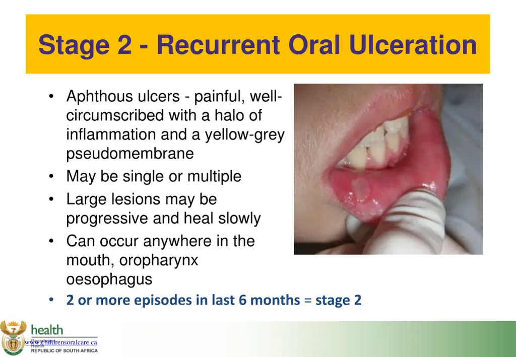 stage 2 recurrent oral ulceration