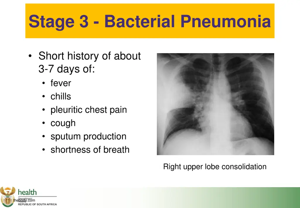 stage 3 bacterial pneumonia