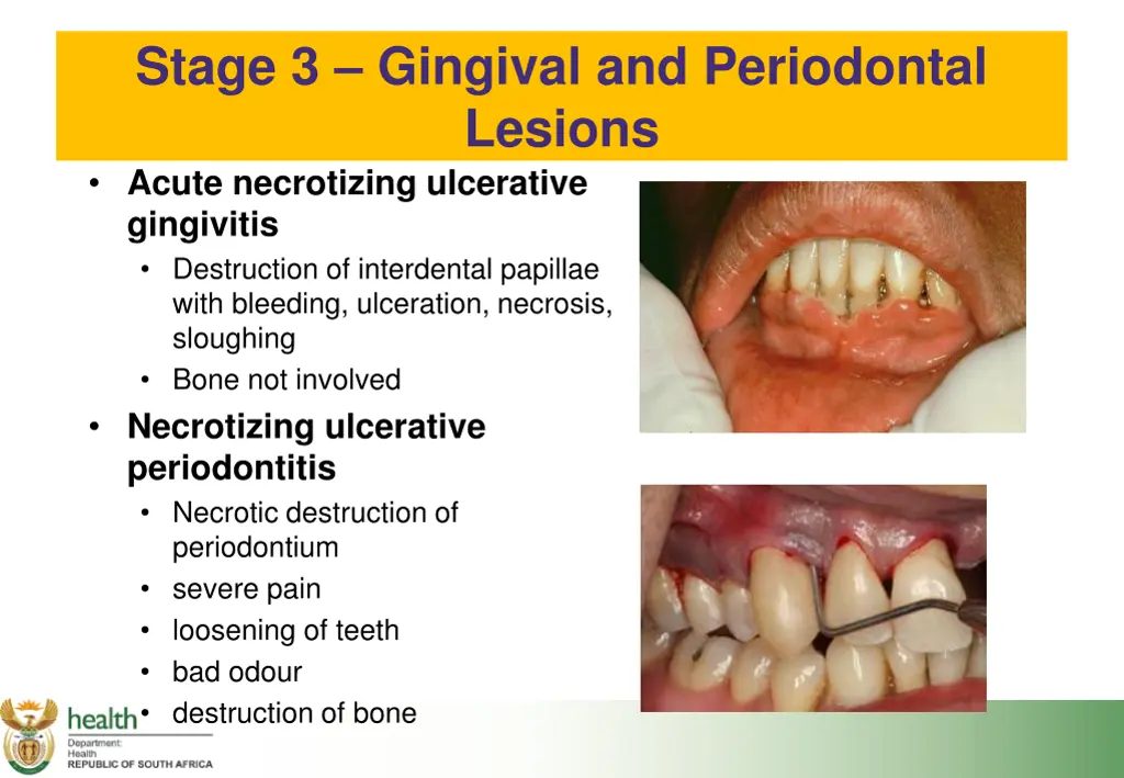 stage 3 gingival and periodontal lesions acute