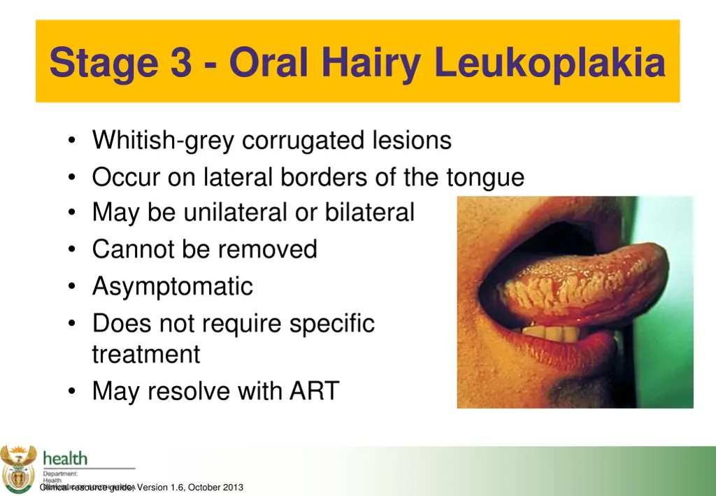 stage 3 oral hairy leukoplakia