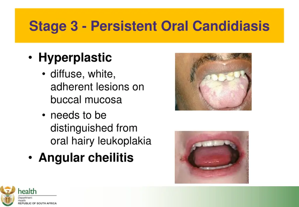 stage 3 persistent oral candidiasis 1