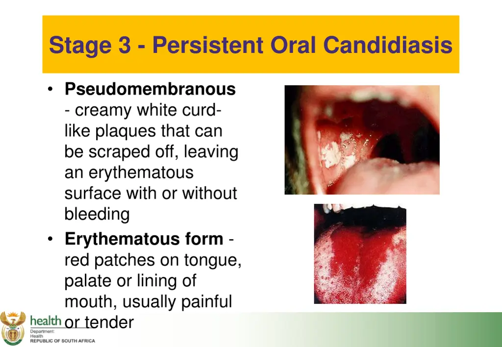 stage 3 persistent oral candidiasis