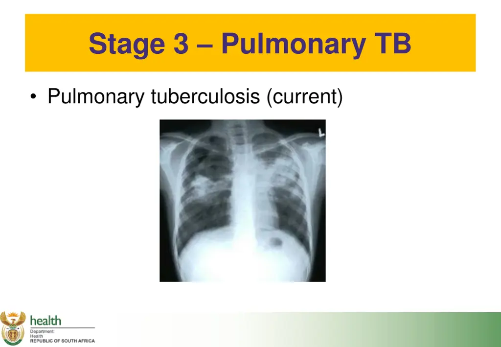 stage 3 pulmonary tb