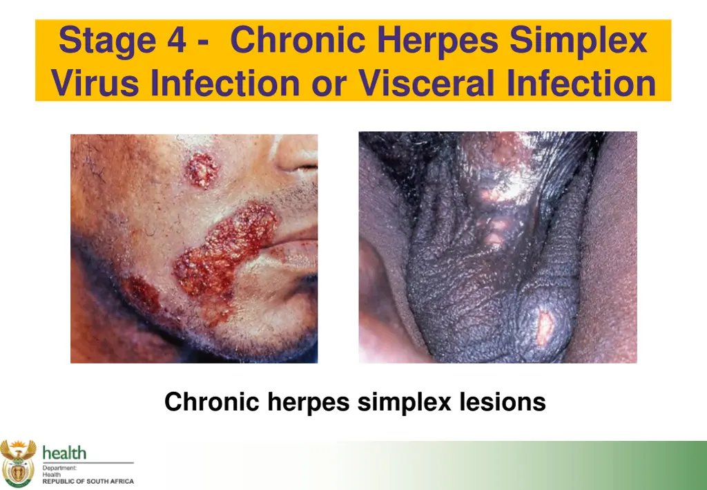 stage 4 chronic herpes simplex virus infection 1