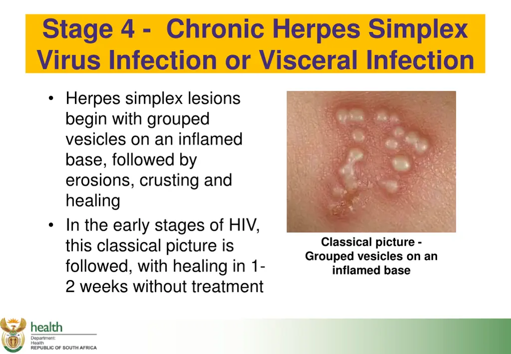 stage 4 chronic herpes simplex virus infection