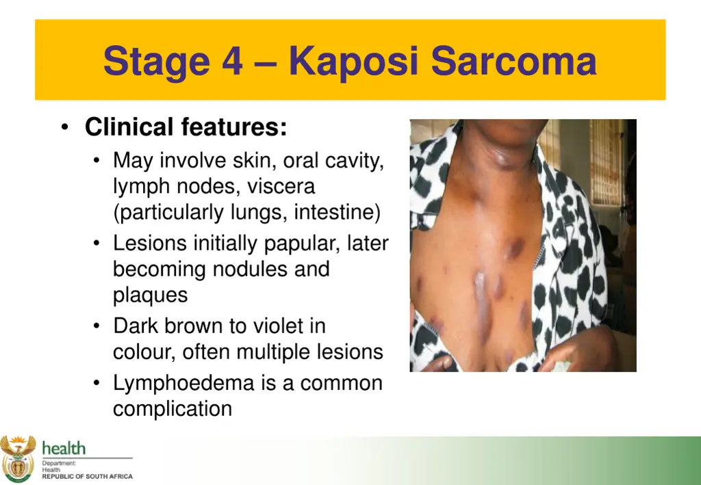 stage 4 kaposi sarcoma