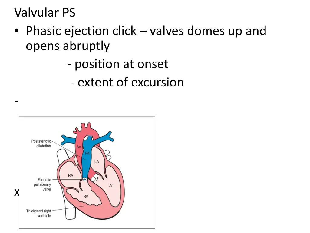valvular ps phasic ejection click valves domes