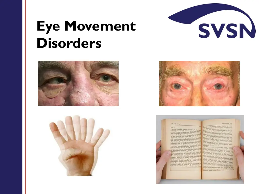 eye movement disorders 1