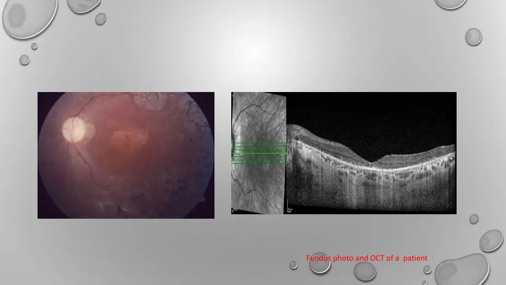 fundus photo and oct of a patient